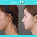 rhinoplasty-in_korea_befor-and-after-06